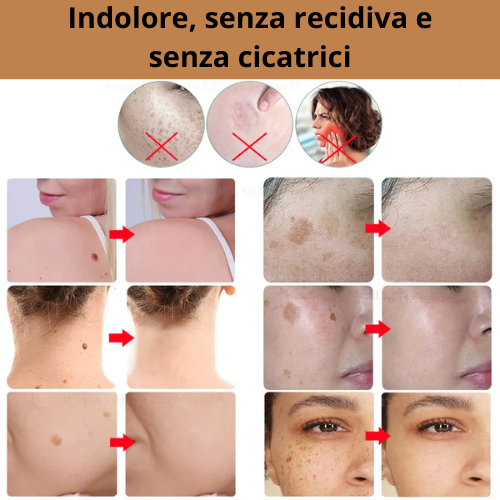 Penna Estetica Professionale al Plasma |Trattamento per Rughe, Macchie, Acne, Verruche e Tatuaggi| Ricaricabile USB-C | Tecnologia Sicura e Naturale.