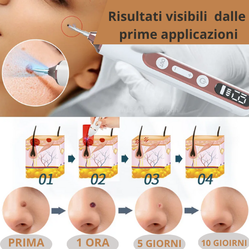 Penna Estetica Professionale al Plasma |Trattamento per Rughe, Macchie, Acne, Verruche e Tatuaggi| Ricaricabile USB-C | Tecnologia Sicura e Naturale.