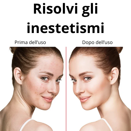 Dispositivo Alta Frequenza per Terapia Facciale 4 in 1 – Bacchetta Galvanica con 4 Elettrodi in Vetro – Anti-Rughe, Rimozione Acne, Stimolazione Capelli, Bellezza Viso.