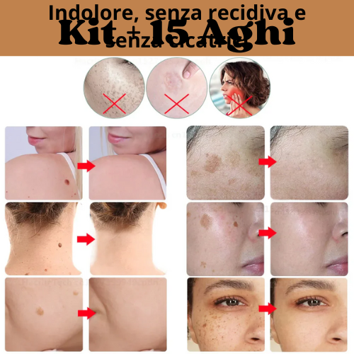 Penna Estetica Professionale al Plasma |Trattamento per Rughe, Macchie, Acne, Verruche e Tatuaggi| Ricaricabile USB-C | Tecnologia Sicura e Naturale.