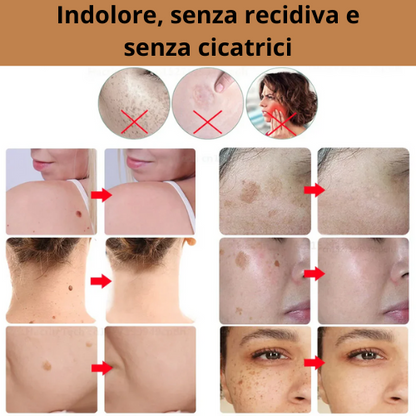 Penna Estetica Professionale al Plasma |Trattamento per Rughe, Macchie, Acne, Verruche e Tatuaggi| Ricaricabile USB-C | Tecnologia Sicura e Naturale.