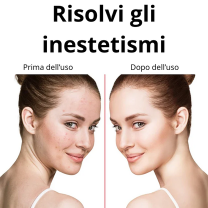 Dispositivo Alta Frequenza per Terapia Facciale 4 in 1 – Bacchetta Galvanica con 4 Elettrodi in Vetro – Anti-Rughe, Rimozione Acne, Stimolazione Capelli, Bellezza Viso.